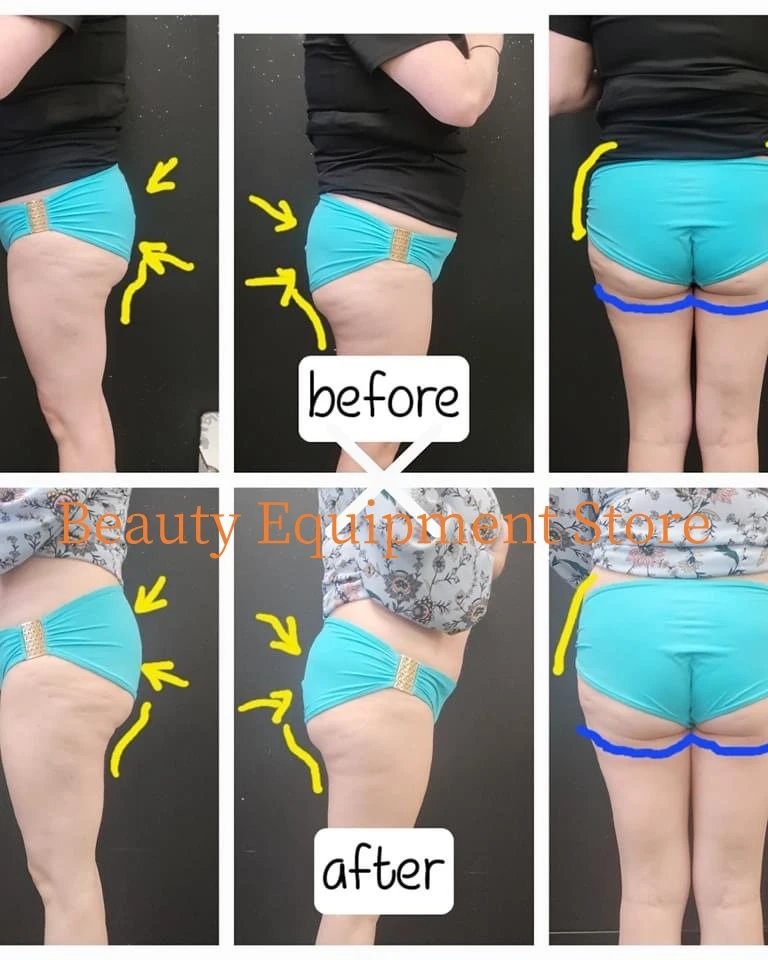 EMS Body Sculpt 15Tesla 6500w Body Slimming EMS Fat Burning Muscle Sculpting Electromagnetic Stimulate Sculpt Therapy Machine EMS Body Sculpt 15Tesla 6500w Body Slimming EMS Fat Burning Muscle Sculpting Electromagnetic Stimulate Sculpt Therapy Machine